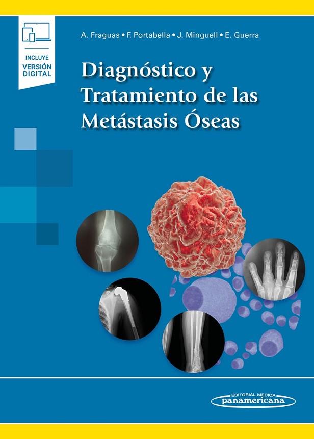 DIAGNOSTICO Y TRATAMIENTO METASTASIS OSEAS (INCLUYE EBOOK) | 9788491107804 | FRAGUAS I CASTANY, ANTONIO / PORTABELLA