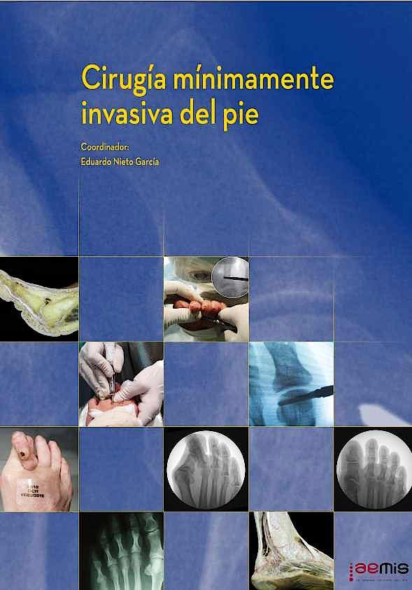 CIRUGÍA MÍNIMAMENTE INVASIVA DEL PIE | 9788474296600 | NIETO, E. / AEMIS (ASOCIACIÓN ESPAÑOLA DE CIRUGÍA DE MÍNIMA INCISIÓN DEL PIE)