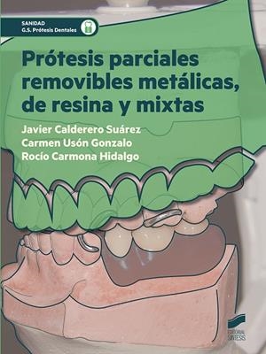 PRÓTESIS PARCIALES REMOVIBLES METÁLICAS, DE RESINA Y MIXTAS | 9788491710288 | CALDERERO SUÁREZ, JAVIER / USÓN GONZALO, CARMEN / CARMONA HIDALGO, ROCÍO