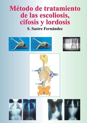 MÉTODO DE TRATAMIENTO DE LAS ESCOLIOSIS, CIFOSIS Y LORDOSIS | 9788447530434 | SASTRE FERNÁNDEZ, SANTOS
